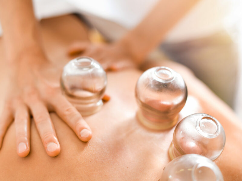 Detail of a woman therapist hands giving cupping treatment on back.